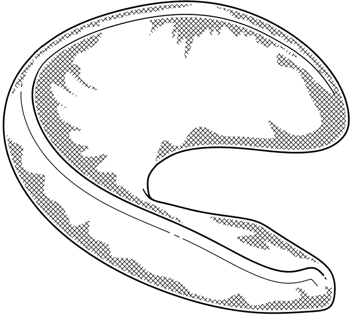 Patent-style line drawing of the meniscal implant viewed from above, showing the crescent-shaped body with cross-hatched regions along its outer margin.